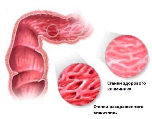 Симптомы и причины раздражённого кишечника